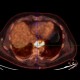 Ectopic pancreas, gigantic, pancreatic ectopia: NM - Nuclear medicine